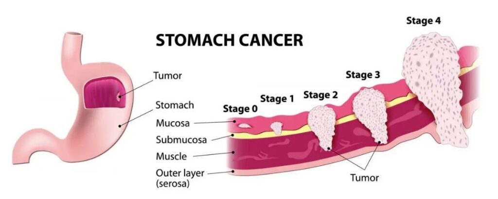 stomach-cancer-symptoms-and-causes-aarogayadham-hospital